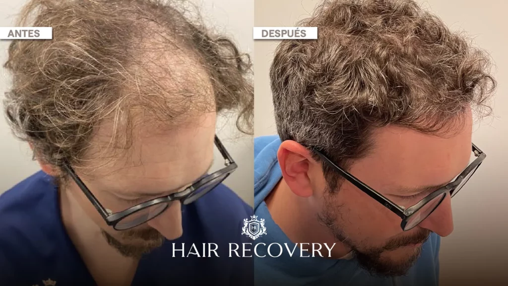 Hair Recovery llega a Villa María de la mano de Roentgen